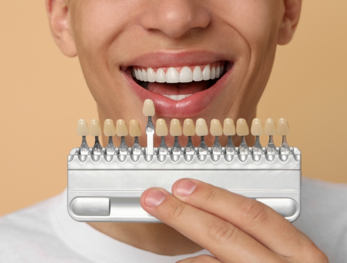 Déroulement d’un traitement par facettes Déroulement d’un traitement par facettes