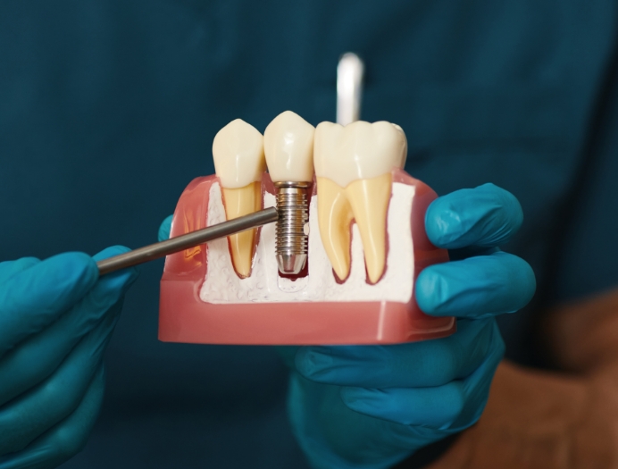 Pourquoi est-il avantageux d’avoir recours à une restauration sur implants Pourquoi est-il avantageux d’avoir recours à une restauration sur implants